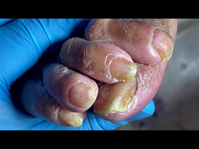 Grown toenails! how did you do that【Pedicure Master Lin Jun】