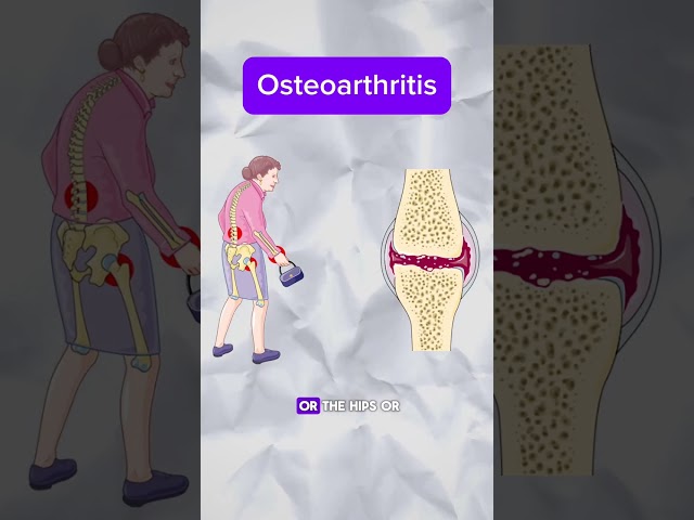 Rheumatoid vs osteoarthritis: Part 1