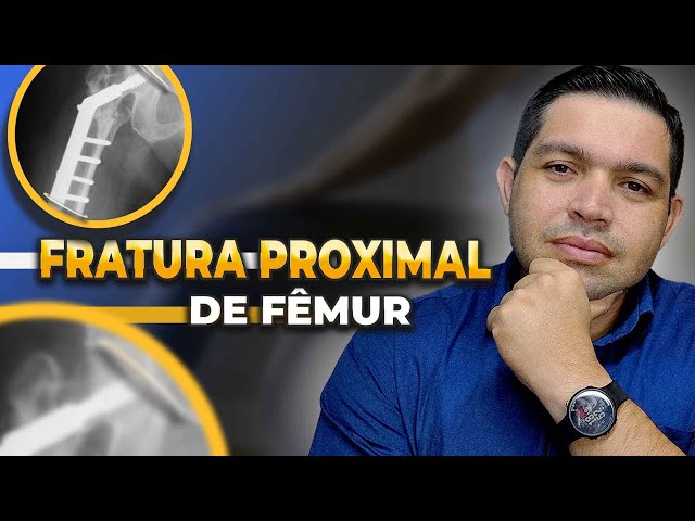 FRATURA DE FÊMUR: O QUE NINGUÉM TE FALOU