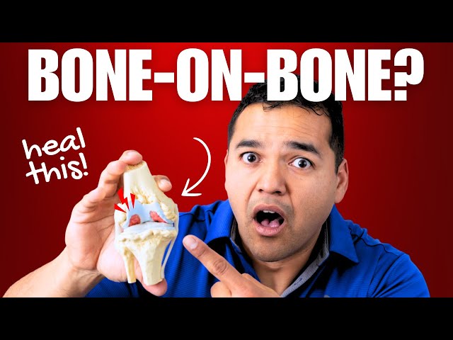 It IS Possible to Heal Knee Arthritis (Even Bone-on-Bone)