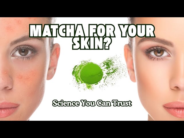 Your Skin Deserves Better. Try Matcha For Psoriasis Treatment