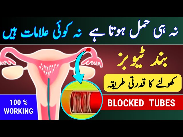 How To Open Blocked Tubes Naturally |Block Fallopian Tube Treatment |Trying To Conceive |Pregnancy