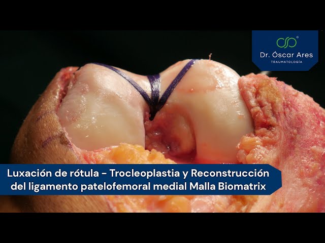 Luxación Rótula Trocleoplastia y Reconstrucción Ligam. patelofemoral medial con Malla Biomatrix