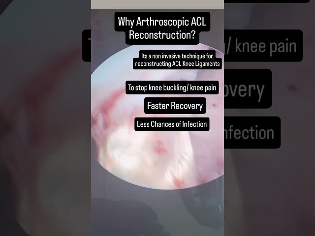 Arthroscopic ACL Reconstruction !! #orthopedics #arthroscopicsurgery #aclrecovery