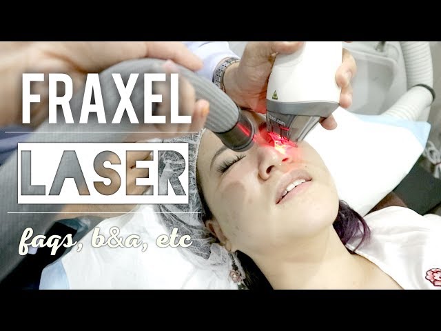 I Tried FRAXEL Laser Treatment for Anti-Aging | Procedure, FAQs, Cost, Recovery, B&A