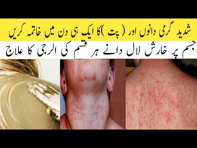 Best Home Remedy For Prickly Heat/Garmi Dano Ka Ilaj/Skin care for Hot Weather/YouTube videos/Viral