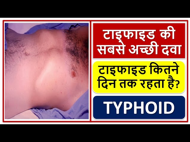 टाइफाइड की दवा, टाइफाइड कितने दिन तक रहता है?, TYPHOID, MEDICINES, TREATMENT, DIAGNOSIS, SYMPTOMS,