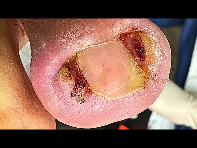 Extreme Double Ingrown Toenail Removal | Satisfying Transformation!