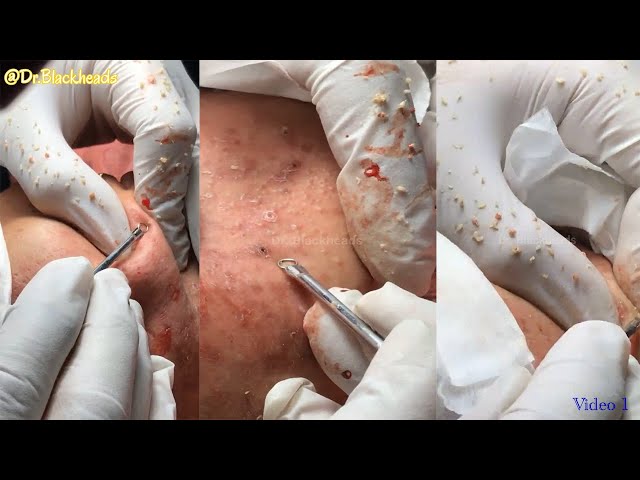 Blackheads Extraction Video with Nice Music | Satisfied Video 01