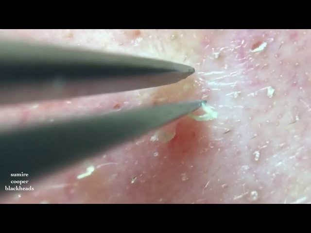 ❣ Acne Treatment Removal By tool   ║  Blackhead Removal Easy ║ Part 61 ✓