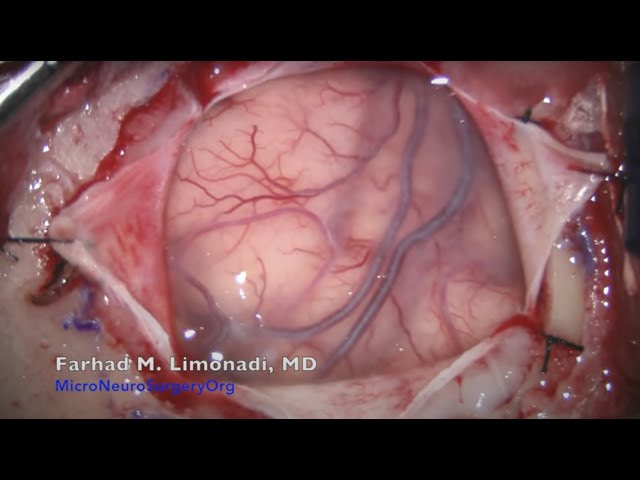 Brain Tumor Surgery: Surgical removal of glioblastoma (GBM)