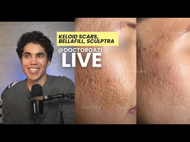 Dr. Qazi discusses Keloid Scars, Silicone Tape, Bellafill | Dr. Qazi Unsponsored Live | 2.12.2025