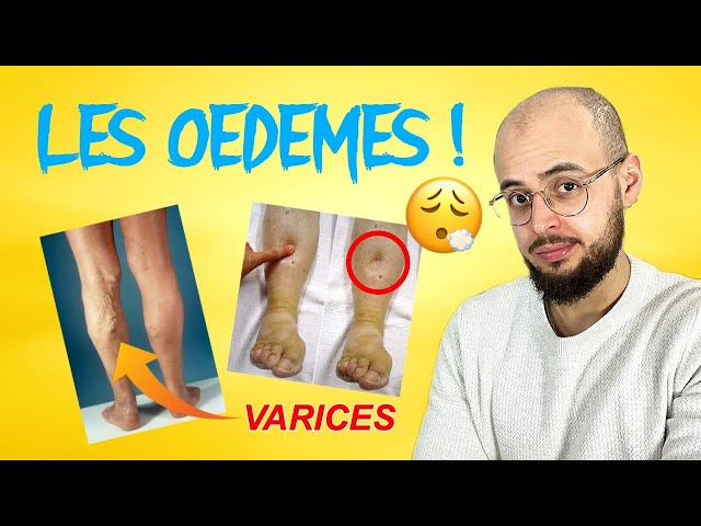 Les jambes qui gonflent. Pourquoi ? Quelles solutions ?