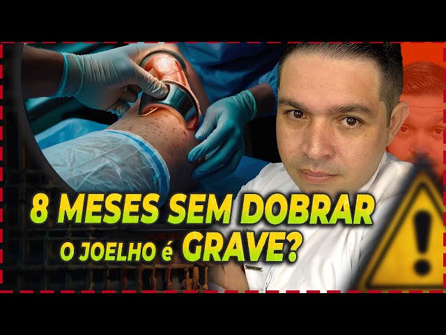 FRATURA DE JOELHO  8 MESES sem DOBRAR é GRAVE? vou começar a FISIOTERAPIA