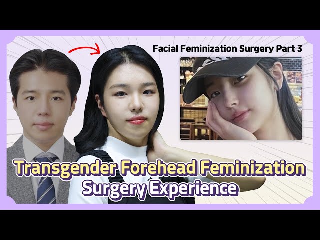 Facial Feminization Surgery Part 3: The Story After Transgender Forehead Surgery