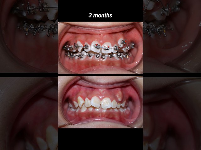 3 years duration braces #braces #orthodontist #dentist #dental