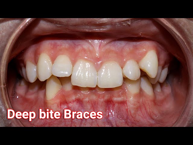 26-Month Braces Journey