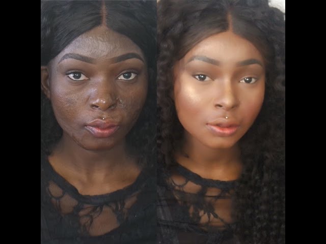 Cover Up Acne & Burn Scar - Highlight And Contour Tutorial