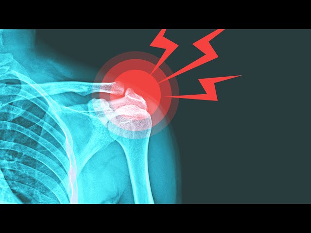 Frozen Shoulder: Best Shoulder Exercises for immediate Pain Relief