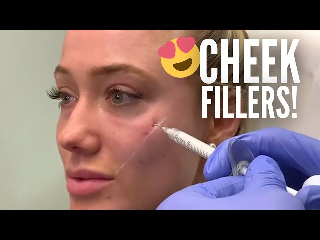 Cheek Fillers 🍎(Using Radiessse)