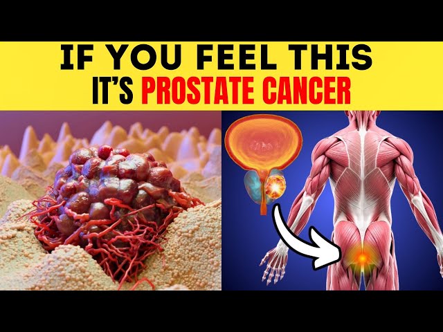 Prostate Cancer: 10 Early Signs and Symptoms. Don’t Ignore!