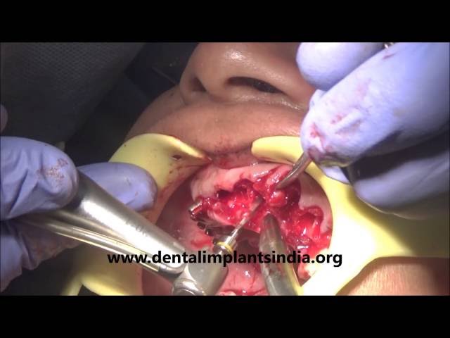 End stage periodontitis treatment with full mouth basal implantology with complete extraction