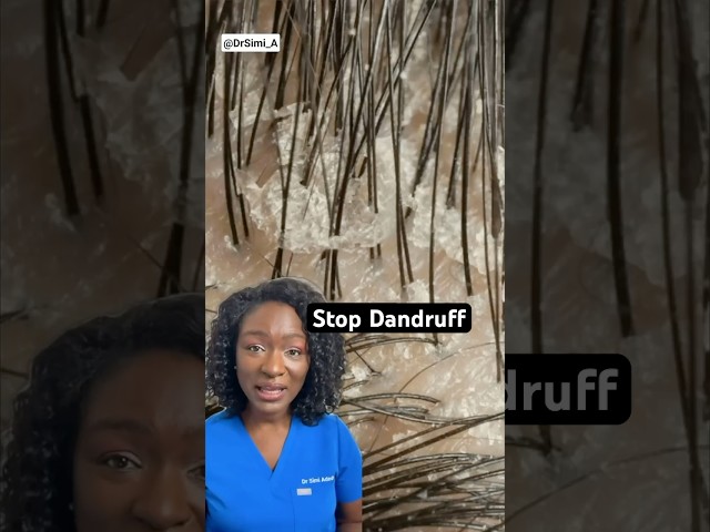 Stop Dandruff + Best Ingredients | Itchy Scalp