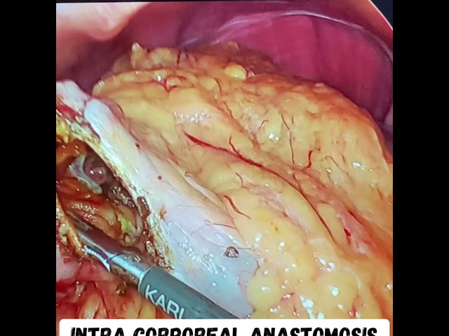 Dr  Iraniha laparoscopic resection surgery of the right colon with primary anastomosis