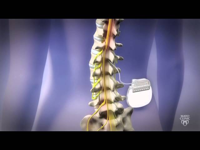 Spine Stimulator for Pain