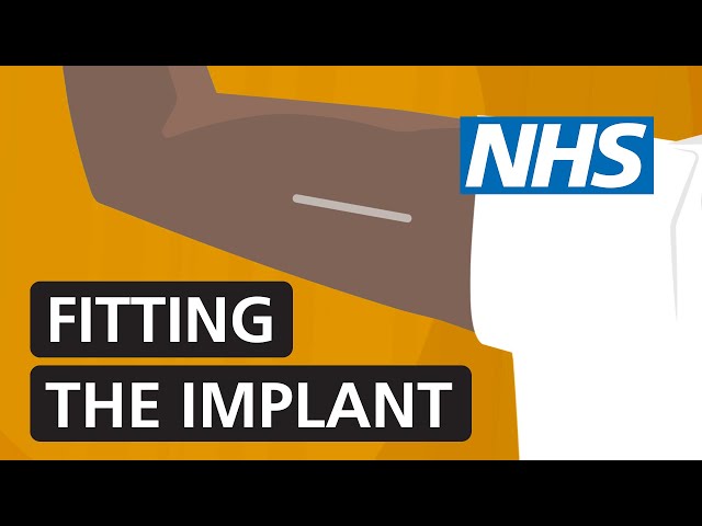 Fitting the contraceptive implant | NHS