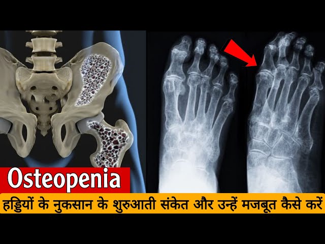 Osteopenia kya hota hai | Osteopenia in hindi | Symptoms | Treatment | Exercises in Hindi