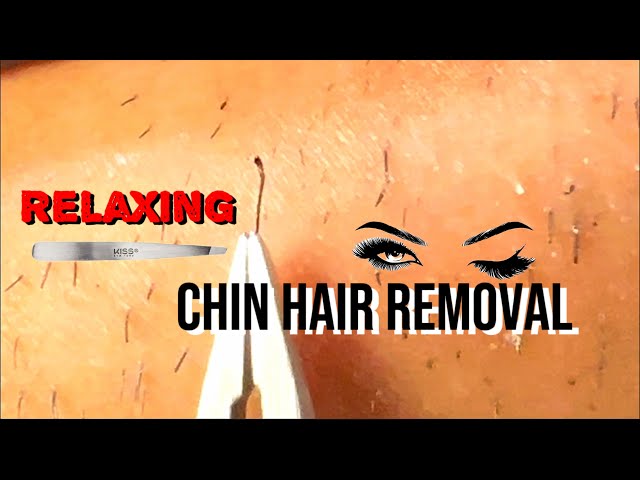 ‼️4K Ingrown Hair Removal -#18 chin hair  |no sound|relaxing| slow| calm| hair pull| satisfying‼️