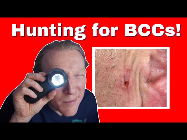 BCC: Basal Cell Carcinoma Skin Cancer: What You NEED to KNOW