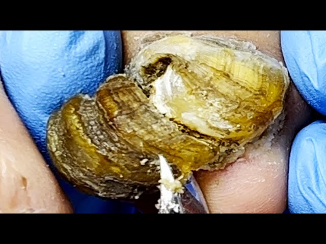 A Large Piece Of Onychomycosis Is Removed Instantly!【Pedicure King】