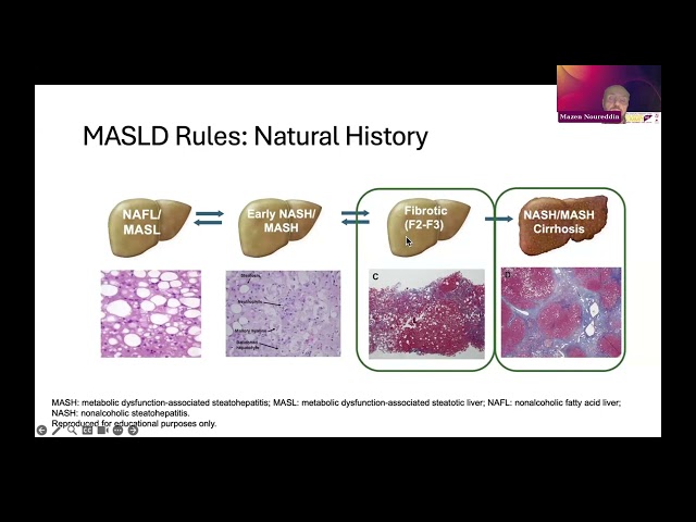 Understanding and Diagnosing MASLD and MASH: What PCPs Need to Know: Session 1: Mazen Noureddin