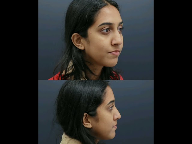 Rhinoplasty - Procedure & Result | Best Rhinoplasty Surgeon in India - Dr Mathew PC  #shorts