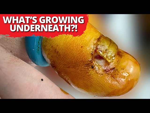 What’s Growing Under This Nail?? You Won’t Believe This!