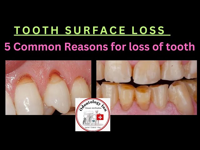 TOOTH ENAMAL LOSS | TOOTH STRUCTURE LOSS DUE TO DENTAL DECAY &  NON-CARIOUS TOOTH SURFACE LOSS