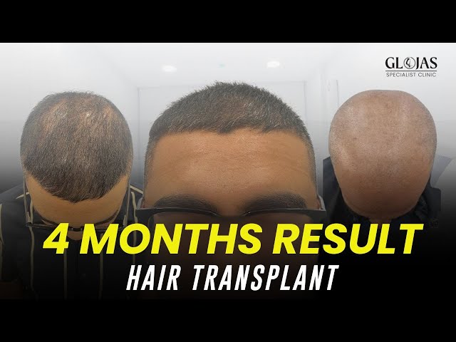 Hair Transplant Journey: M-Shaped Hair Loss Transformation & 4-Month Progress