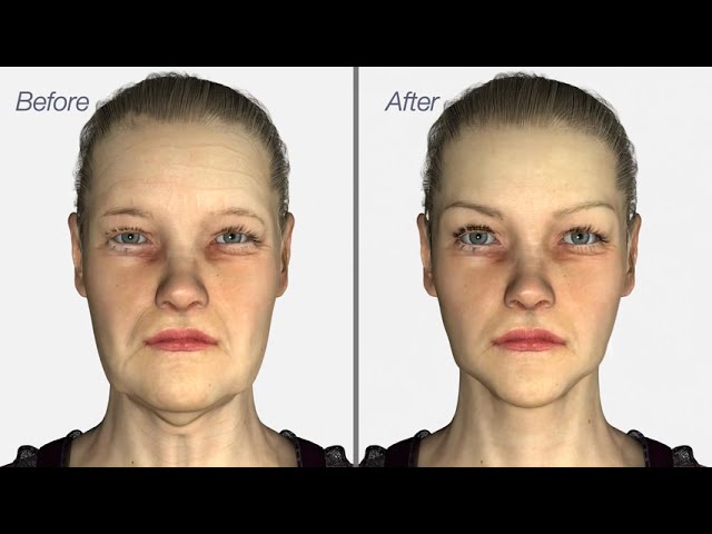 Facelift & Neck Lift surgery - Dr. Julian De Silva - 3D medical animation