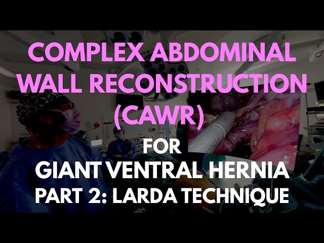 Laparoscopic Complex Abdominal Wall Repair in VR