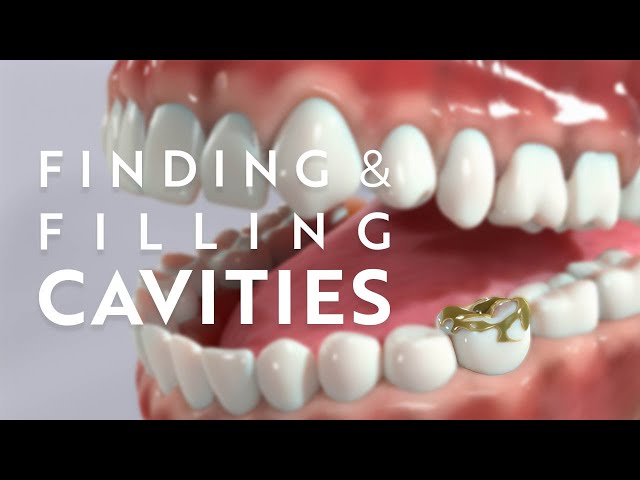 The process of finding and filling dental cavities