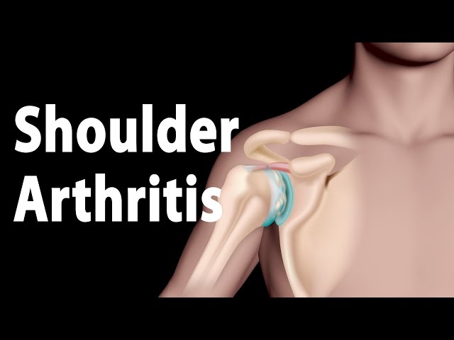 Shoulder Arthritis Narrated Animation.