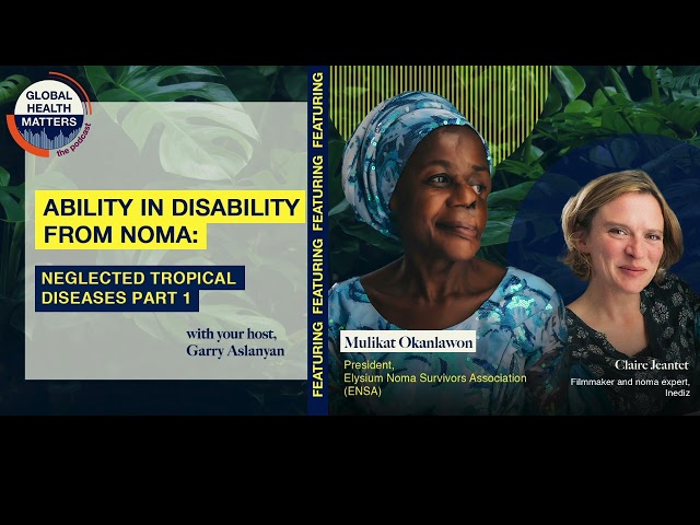 E43 - Ability in disability from noma: neglected tropical diseases part 1 -#GlobalHealthMatters