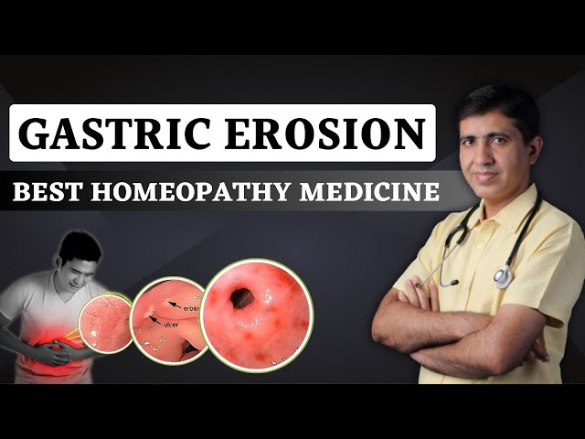 Gastric Erosion क्या है ? , कारण, लक्षण और इलाज | Best Homeopathy Medicine