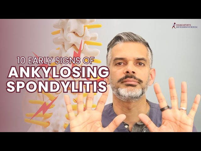 10 Early Signs of Ankylosing Spondylitis You Shouldn’t Ignore!