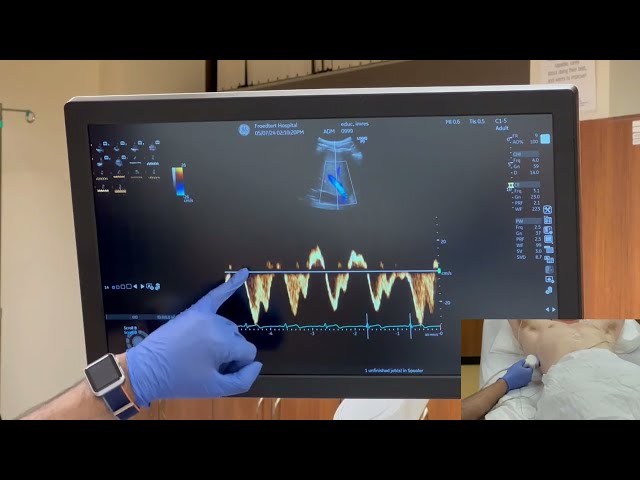 How to perform VExUS scan (Venous Excess Ultrasound) I Dr. Koratala I POCUS