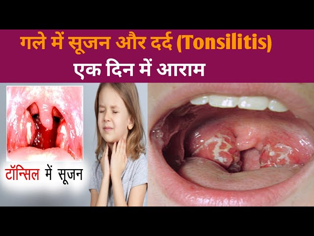 टॉन्सिल के घरेलू उपचार ||गले में दर्द का घरेलू इलाज||home remedies for tonsillitis