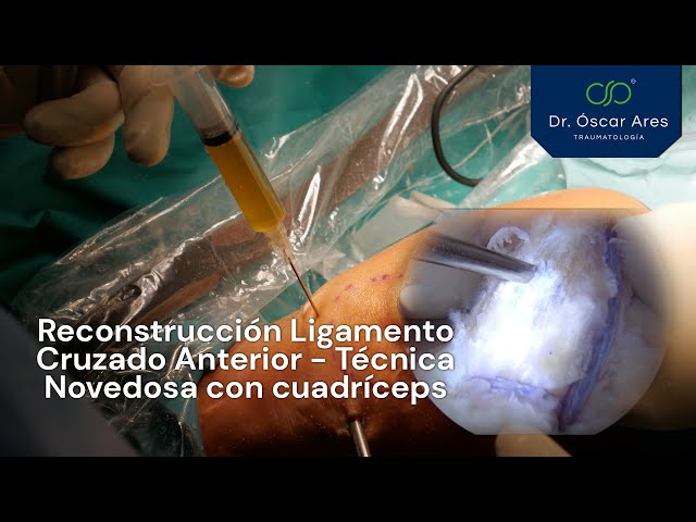 Reconstrucción Ligamento Cruzado Anterior - Técnica Novedosa con cuadríceps - Dr. Oscar Ares