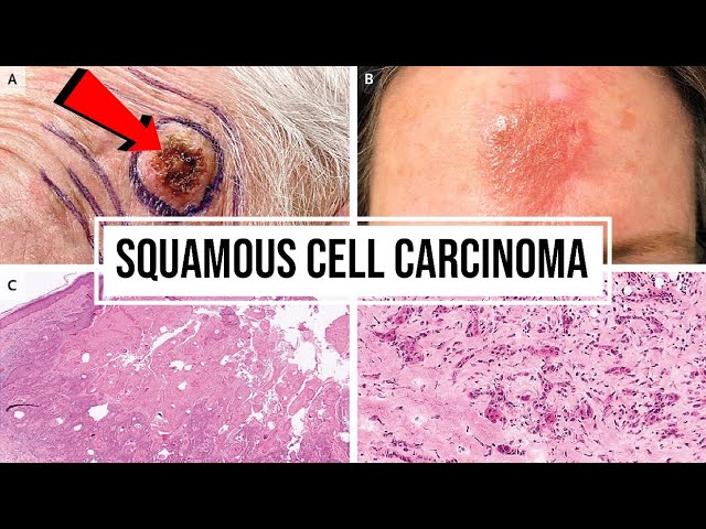 Squamous Cell Carcinoma: Its Symptoms, Causes, Treatment & Types